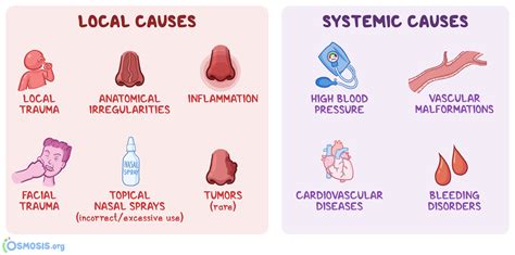 Epistaxis: What Is It, Types, Causes, Prevention,, 57% OFF