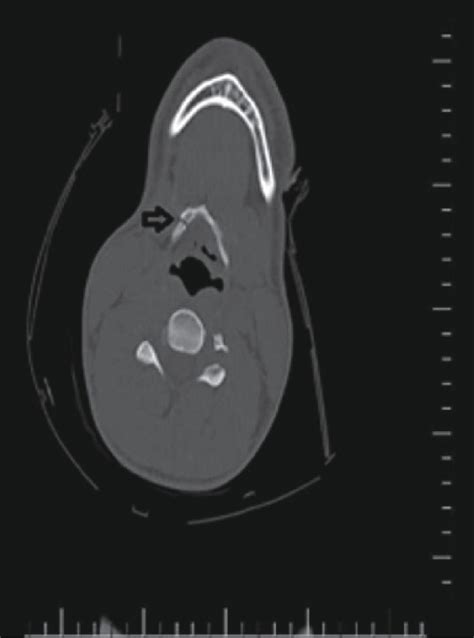 [PDF] An Extremely Rare Isolated Hyoid Bone Fracture in a Patient ...