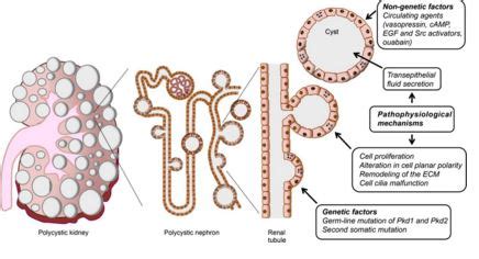 Polycystic Kidney Disease Symptoms, Treatment, What is?