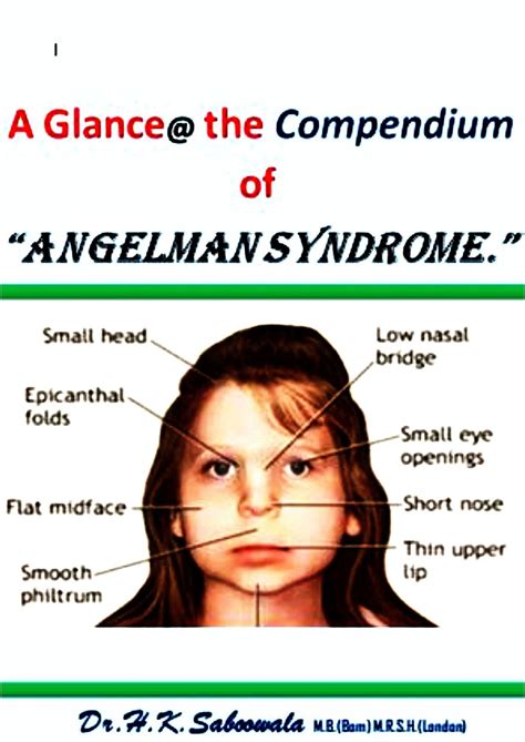 A Glance at the Compendium of “ ANGELMAN SYNDROME.” eBook by Dr ...