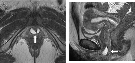 Figure 2 from Adult-onset Skene's gland cyst following a history of ...