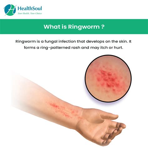 Ringworm: Symptoms, Diagnosis and Treatment – Healthsoul