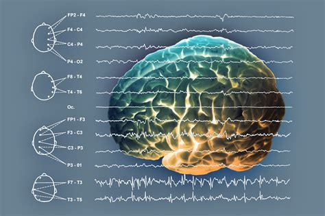 Myoclonic-Atonic Seizures and Lennox-Gastaut Syndrome Present With ...