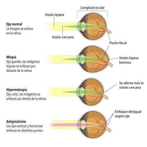 Cirurgia refrativa a laser - De Martini Oftalmologia - Santa Maria