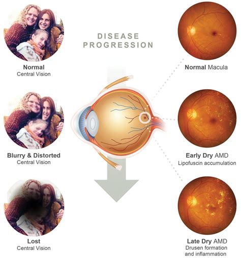 A Clear View of Common Retinal Diseases Affecting Vision - Healthy ...