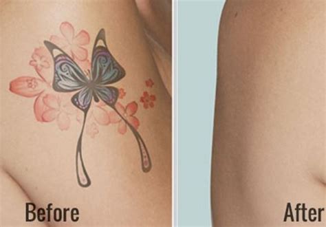 7 best Dermabrasion Tattoo Removal images on Pinterest | Laser tattoo ...