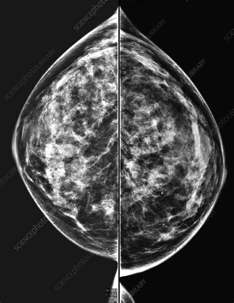 Normal dense mammogram - Stock Image - C039/3387 - Science Photo Library