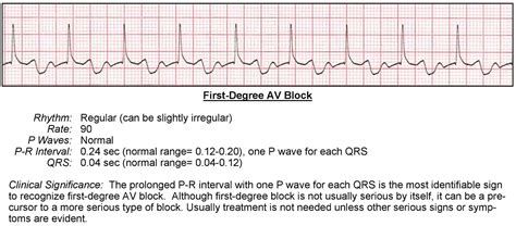 Atrioventricular Blocks - ACLS Wiki