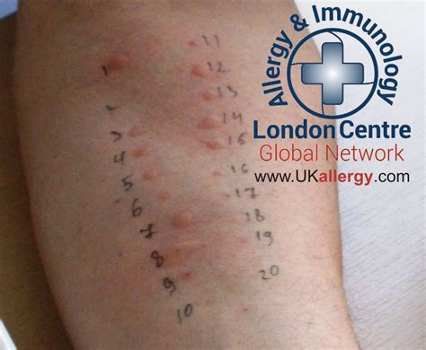 Skin Allergy Testing London, Skin Prick Testing London