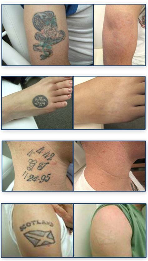 Tattoo Removal Before and After | Tattoo removal, Laser tattoo, Laser ...