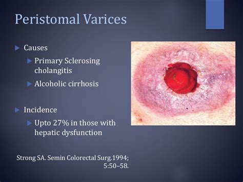 Stoma complications & its management