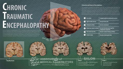 Chronic Traumatic Encephalopathy | AMI Cleveland 2015