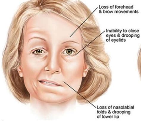 Facial Palsy – St Mark Rehab | Physical Therapy Outpatient Clinic