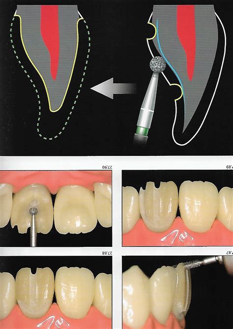 Anterior Crown Preparation | Dental Esthetics