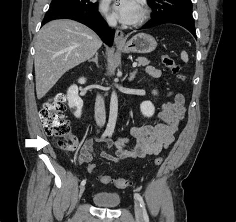 Appendiceal Goblet Cell Adenocarcinoma Case Report and Review of the ...