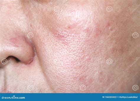 Allergy rash on the face stock photo. Image of hives - 166265422