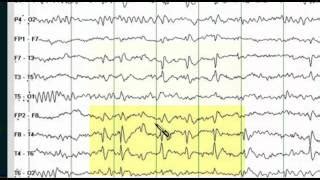 Normal Versus Abnormal Eeg