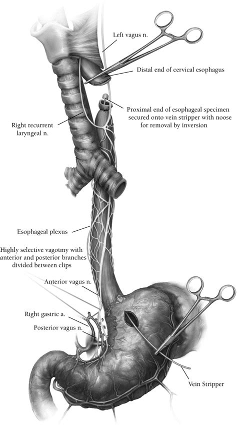 Colonic Interposition for Benign Disease - Operative Techniques in ...