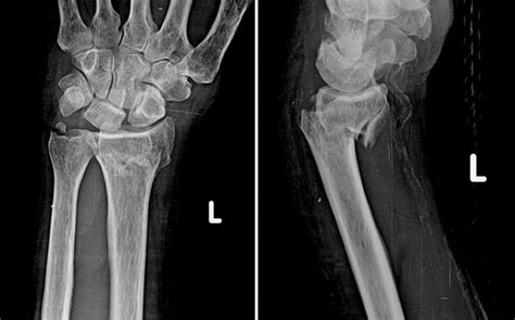 Smith Fracture Radiology