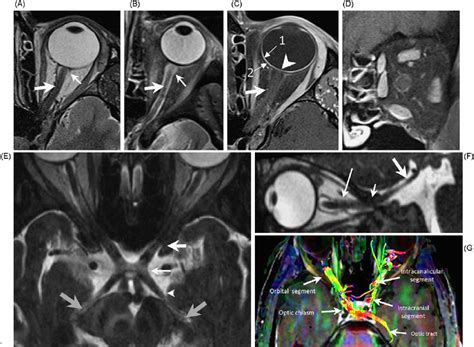 Normal anatomy of the optic nerve, chiasm and optic tracts. Axial T2 w ...