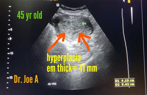 Ultrasound imaging: Cystic-endometrial-hyperplasia-3D ultrasound