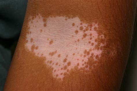 Vitiligo - Causes, Symptoms, Vitiligo Skin Disease Treatment