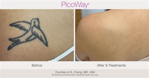 PicoWay Laser Tattoo Removal – Synergy Medical Aesthetics – Nanaimo ...