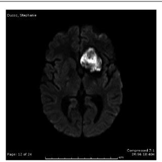 Diffusion weighted sequence showing restricted diffusion in brain stem ...