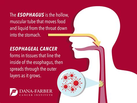 Esophageal Cancer Signs & Symptoms | Dana-Farber Cancer Institute