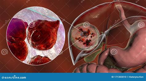 Liver Cyst Illustration | CartoonDealer.com #190761670