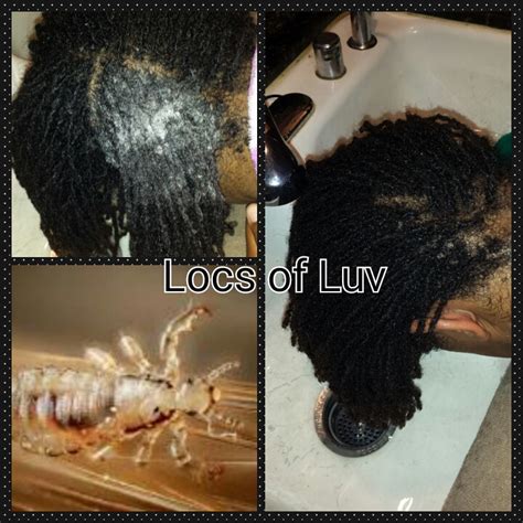 Can Lice Live In African American Hair