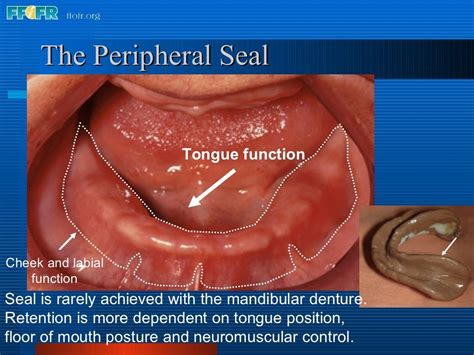 26.posterior palatal seal