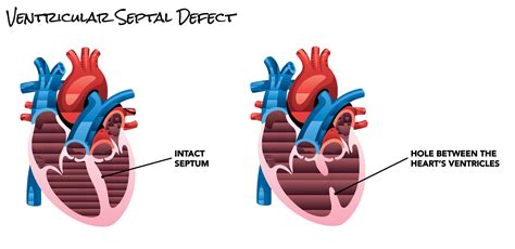 Ventricular Septal Defect (VSD) | SCAI - Seconds Count