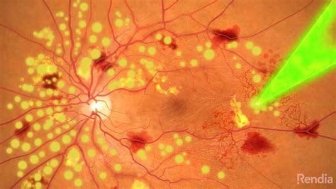 PRP - Pan Retinal Photocoagulation | Freedom Eye Laser — Freedom Eye Laser