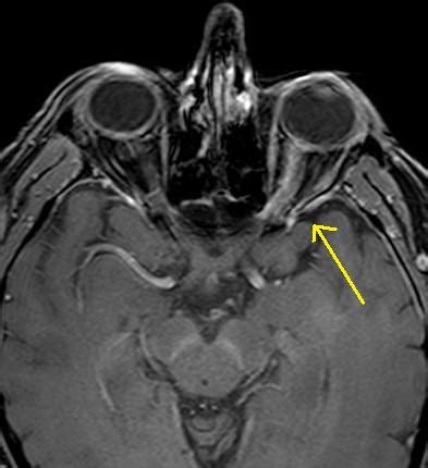 Optic Neuritis-MRI - Sumer's Radiology Blog