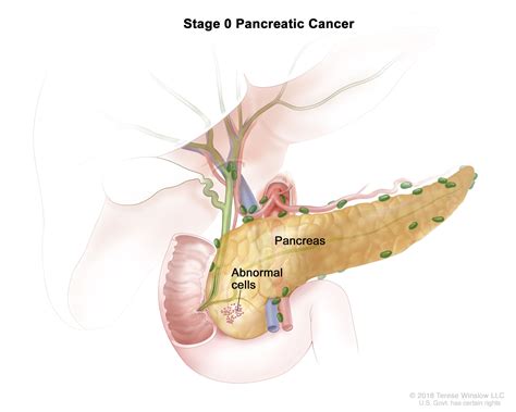 Pancreatic Cancer | Vanderbilt-Ingram Cancer Center