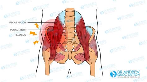 Hip Flexor Strain: A Guide to Understanding and Healing | A/Professor ...