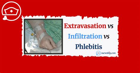 Extravasation vs Infiltration vs Phlebitis: Local Complications of ...