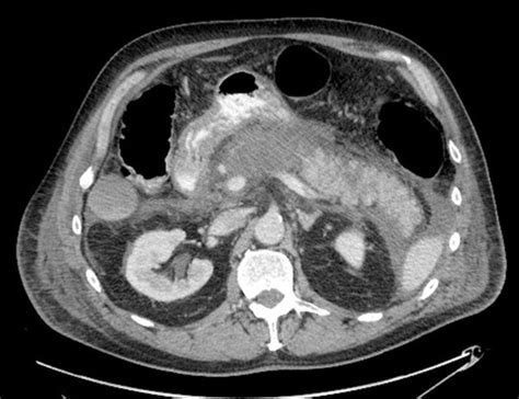 Normal Pancreas Cat Scan