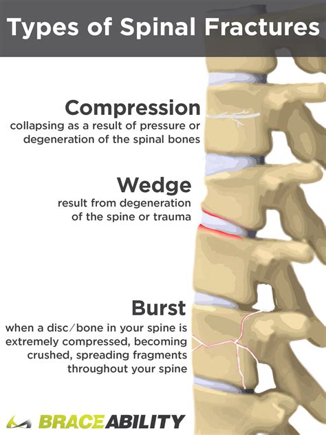 Difference Between Wedge, Compression, & Burst Spinal Fractures ...