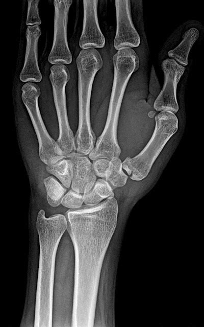 Radshare: BENNETT'S fracture