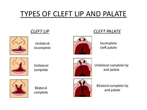 Stem cell therapy in cleft lip and palate