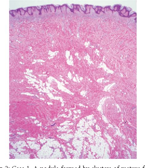 Figure 5 from Nevus Lipomatosus Superficialis with a Folliculosebaceous ...