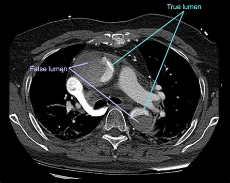 CT Case 006 • LITFL • CT scan interpretation