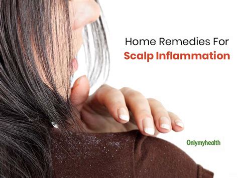 Scalp Inflammation Home Remedies: These 5 Signs Of Scalp Inflammation ...