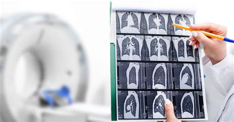 What to Expect from Low-Dose CT Scan Lung Cancer Screening