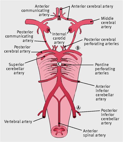 Posterior circulation ischaemic stroke | The BMJ