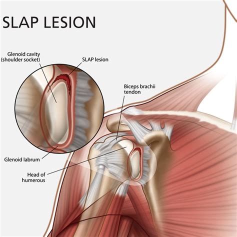 Glenoid Labrum Tear: SLAP Lesion - Shoulder Pain differential Diagnosis