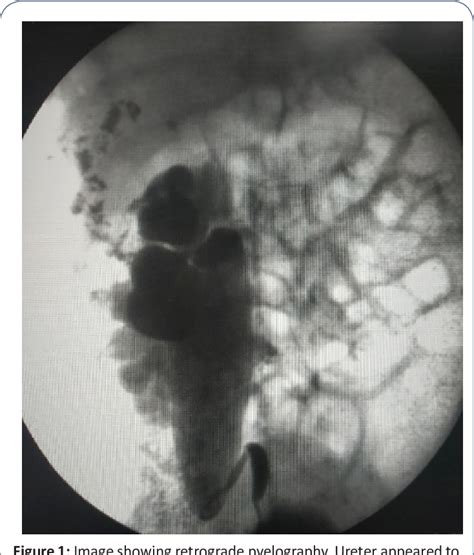 Figure 1 from Pelviureteric Junction Obstruction in an Ectopic Right ...