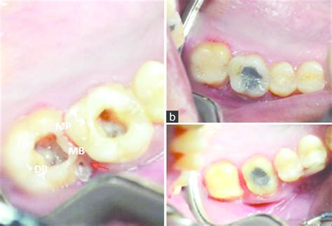 Clinical images of maxillary right first and second molars: (a ...